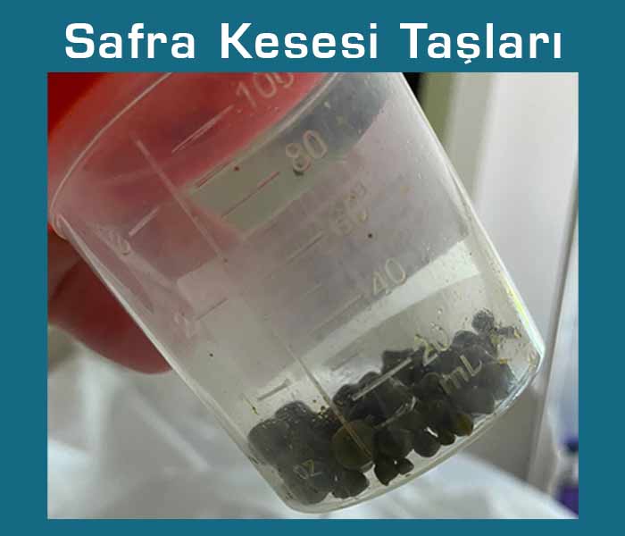 Safra kesesi taşları